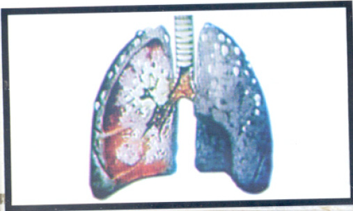 Jordan 2005 Health Effects lung - diseased organ, no text